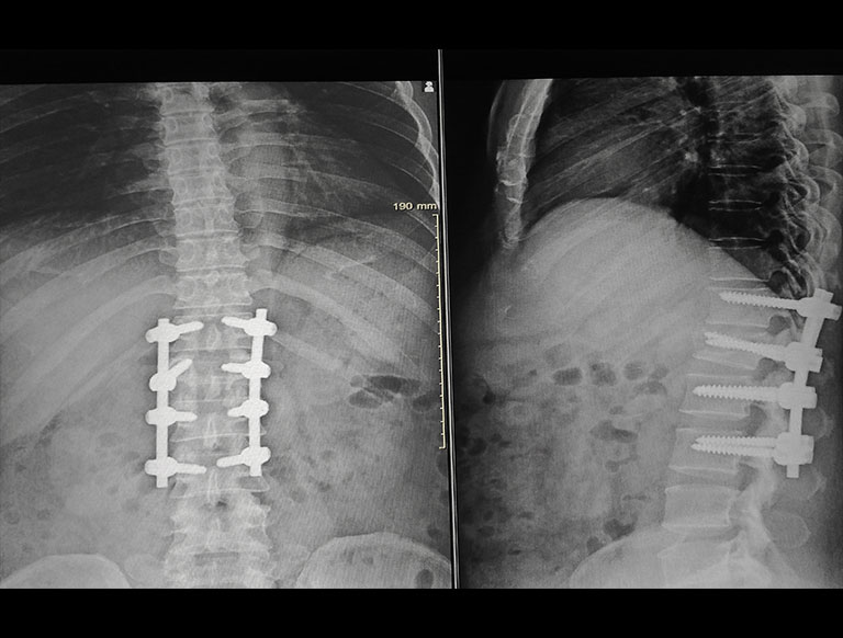 Full Endoscopic Spinal Fusion Asian Spine Hospital