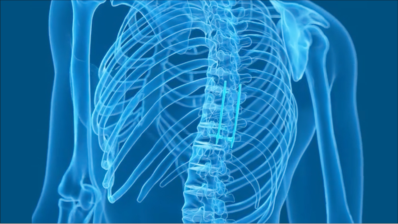 Full Endoscopic Spinal Fusion Asian Spine Hospital